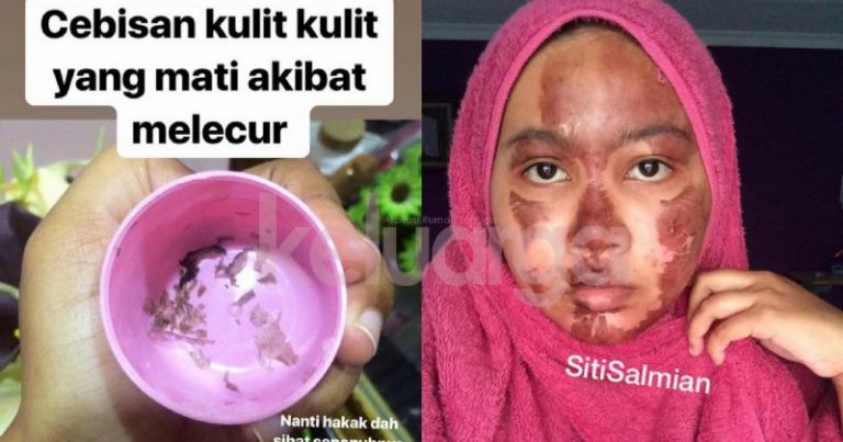 Muka Melecur Teruk Gara-gara ‘Pressure Cooker’ Meletup, Dugaan Sebulan Sebelum Kahwin, Ibu-ibu Sila Pantau Anak Ya!
