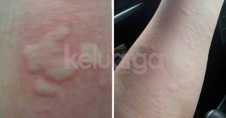 Jangan Cemas Bila Anak Terkena ‘Kelopak Garam’, Ini Ibu Ayah Patut Buat!