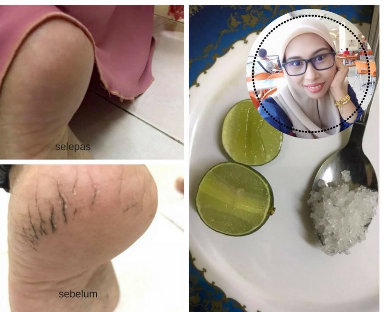 7 Cara Hilangkan Kesan Tumit Kaki Merekah & Wanita Ni Amalkan Satu Daripadanya. Memang Menjadi!