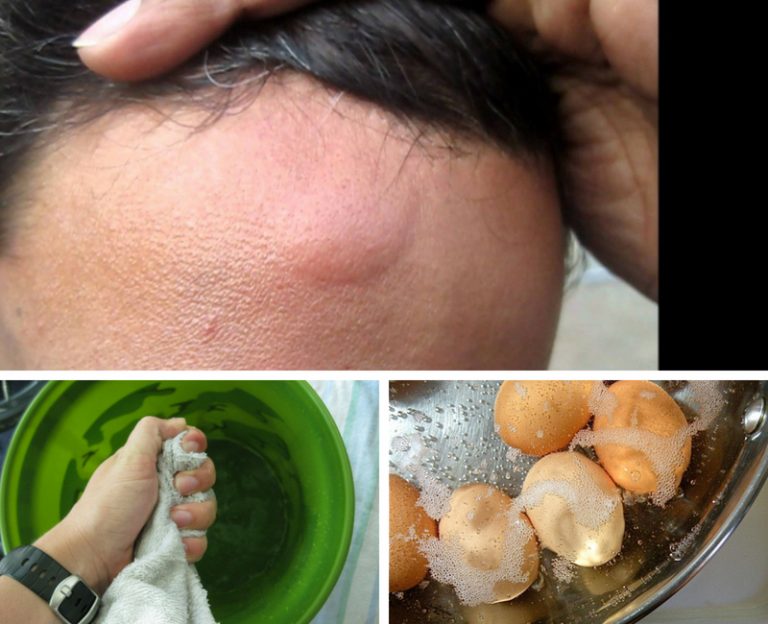 Kesan Bejol Atau Lebam Boleh Reda Dengan 5 Petua. Mudah Sangat!