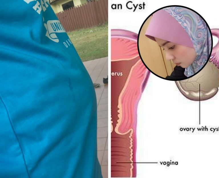 Perut Buncit Macam Mengandung, Rupanya Ibu Anak 2 Ini Kena Kenser Ovari!