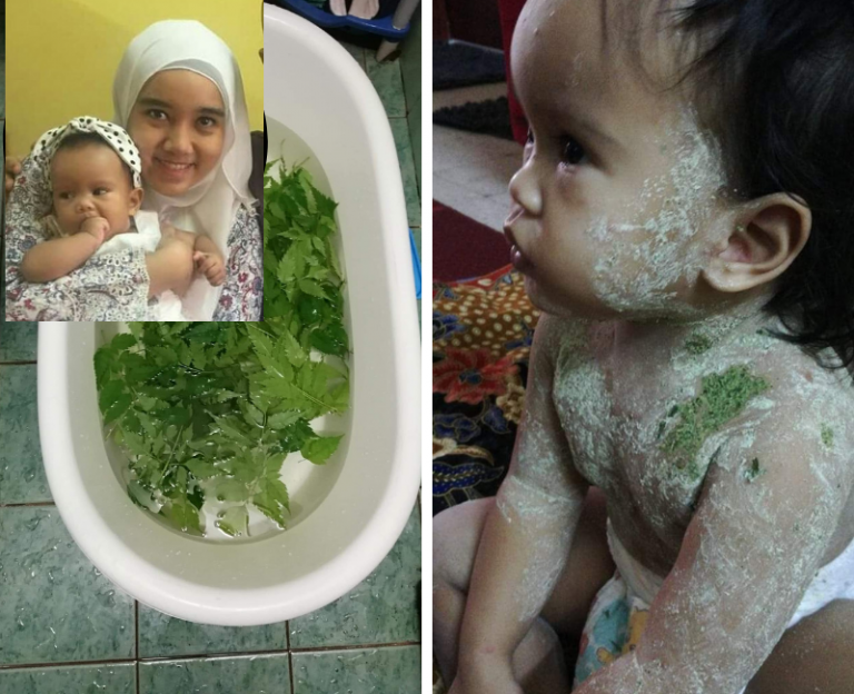 Chickenpox Selain Guna Losyen Dari Klinik,  Ibu Ni Kongsi Petua Lain Untuk Cepat Sembuh!