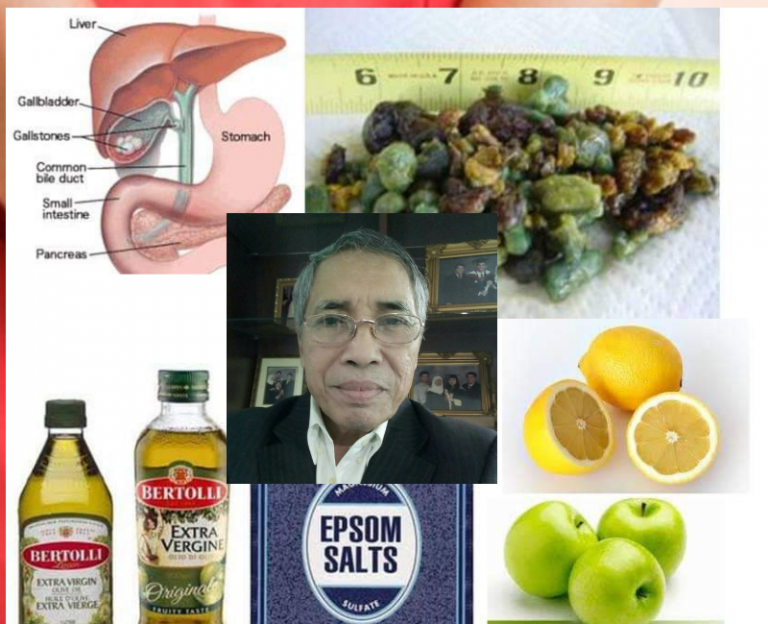 Dr. Hamid Arshat Kongsi Amalan Pecahkan Batu Karang Hempedu!