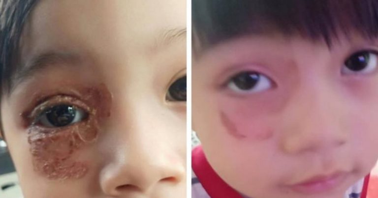 “Lambat Rawat, Kemungkinan Tak Nampak Sebelah.” Ibu Ini Kongsi Pengalaman Mata Anak Dijangkiti Kuman Dari Kucing Terbiar.