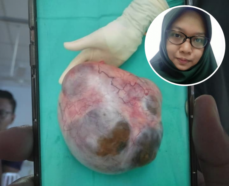 Perut Dah Macam Mengandung 7 Bulan, Rupanya Ada Cyst Sebesar 28cm. Anak Dara Ni Kongsikan Pengalamannya!