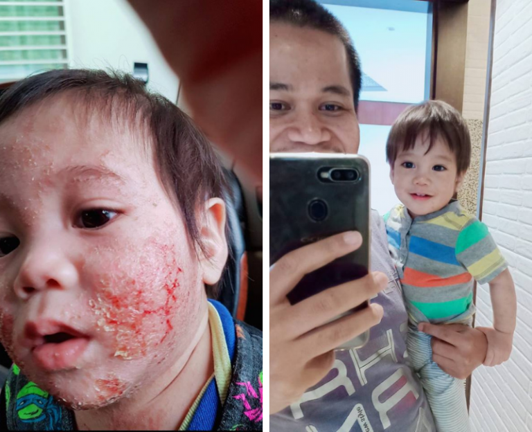 Bermacam Cara Dah Buat Untuk Rawat Ekzema Anak, Tapi Gagal. Akhirnya Tekad Guna Kaedah Kawal Pemakanan!