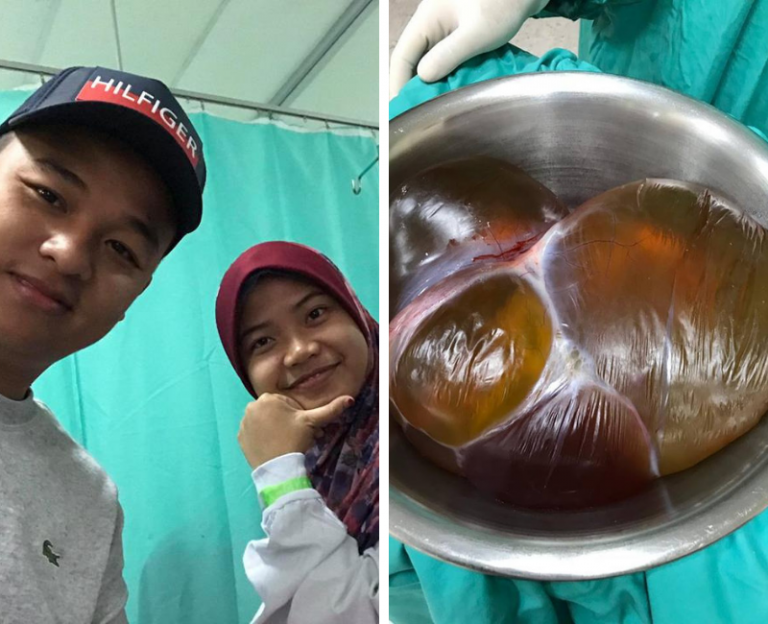 Wanita Ni Ingatkan Mengandung, Rupanya Ada Cyst. Bukan Calang-calang Saiznya, Kantung Bersaiz 30cm Berisi Cecair!