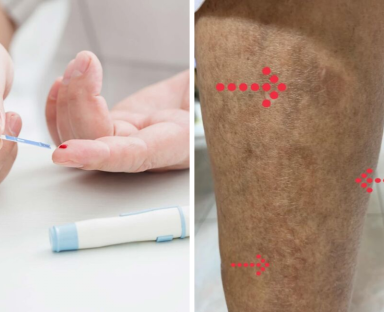 Bertahun-tahun Hidap Kencing Manis, Jangan Sampai Kaki Bertompok. Itu Petanda Serius, Dr Ni Dedahkan Agar Ramai Faham!
