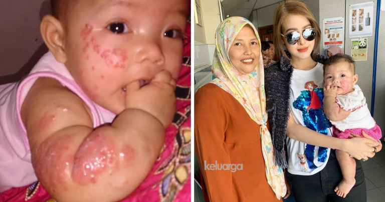 “Kulit Dah Mengelupas & Pedih Berdarah.” Eina Azman Sekali Lagi Bantu Bayi Ekzema Jumpa Pakar Kulit