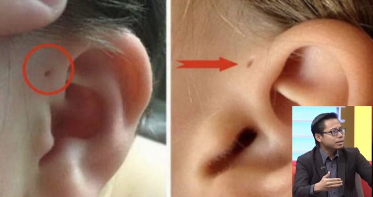 Bila Ada Cecair Keluar Dari Lubang Kecil Di Hadapan Telinga Anak. Ini Ibu Ayah Kena Buat.