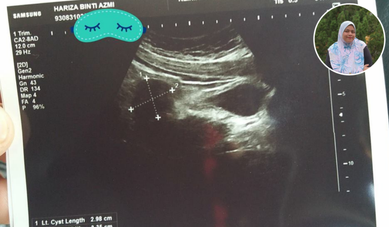 Beberapa Kali Kena Cyst. Akhirnya Doktor Nasihatkan Ni Padanya & Dikongsikan Untuk Info Bersama!