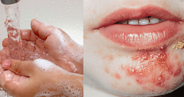 Ini Bahayanya Impetigo Pada Anak. Kena Alert.