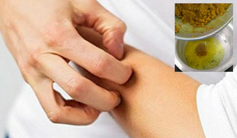 Kulit Terasa Gatal  Atau Ekzema, Redakan Dengan Minyak Kunyit  Homemade Ni.