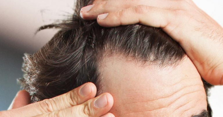 Orang Lelaki Elak Gayakan Rambut Dengan Kerap. Boleh Botak Di Awal Usia!