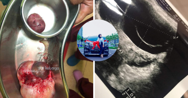 “Pakar Suruh Operate, Detect Cyst Siap Ada Rambut.” Disangka Badan Berangin, Rupanya Ada Cyst!