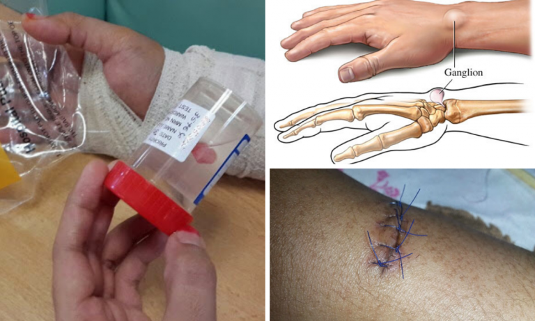 Pergelangan Ada Benjolan Saiz Guli, Jika Dibiarkan Lama Akan Sakit. Wanita Ni Kongsi Pengalaman Prosedur Operation ‘Ganglion Cyst’!