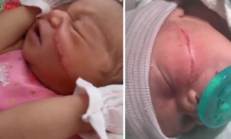 Ibunya Bersalin Secara Czer, Bayi Ni Terpaksa Terima 13 Jahitan Di Pipi!