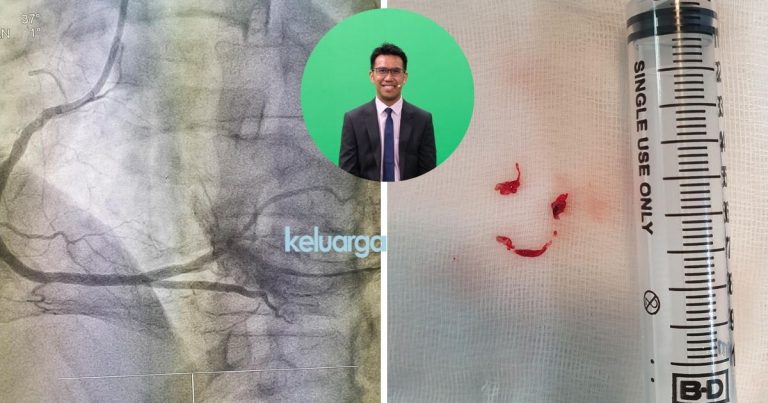 Lelaki 40an Hampir Maut Akibat Stress, Darah Beku Tersumbat Di Salur Darah Jantung. Take Note Peringatan Dr Ini.