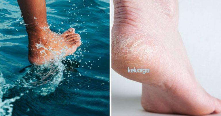 Pesakit Diabetes Take Note Bila Tapak Kaki Merekah, Dr Ini Jelaskan Punca Dan Cara Pencegahan.