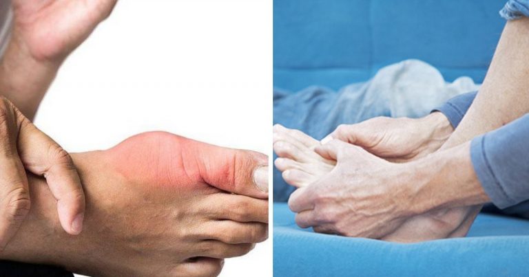 Ubat Tradisi Sakit Gout Amalkan Je Yang Ni Untuk Redakan Kesakitan. Ramun Pun Mudah Dapat, Boleh Buat Sendiri!