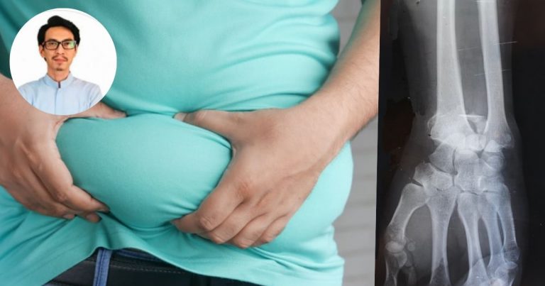 “Tiada Istilah Tulang Besar…” -Dr Ni Jelaskan Berat Terlebih Bukan Sebab Tulang!