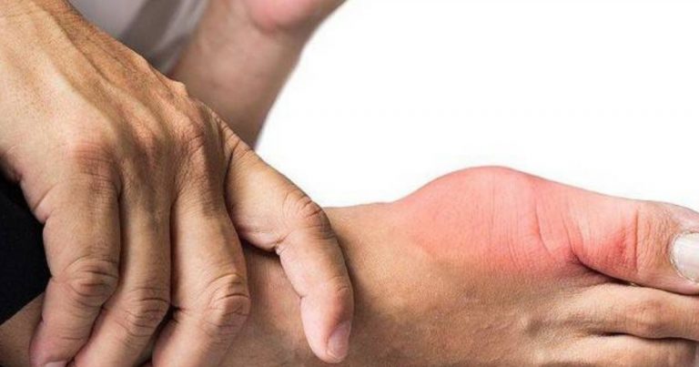 Bukan Sebab Banyak Makan Makanan Laut Je Boleh Kena Gout. Dr Ni Jelaskan Sila Take Note!