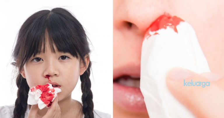 Risau Anak Kerap Hidung Berdarah, Pakar Ini Jelaskan ‘Step’ Mudah  Nak Atasi.