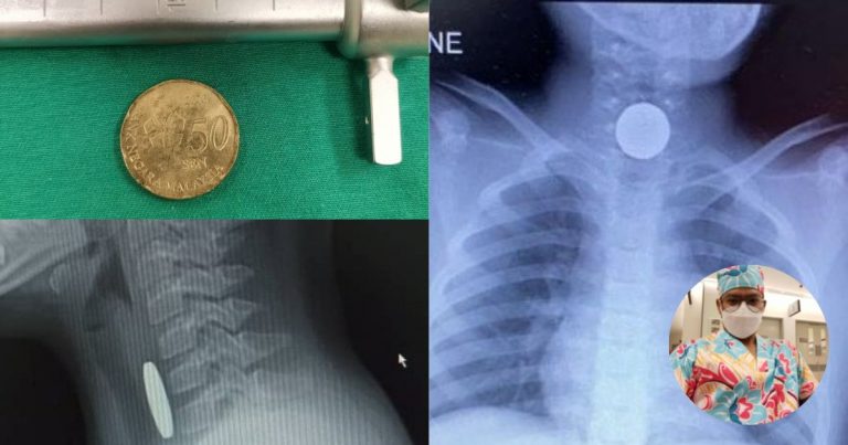 “Jangan Biasa Ajar Anak Main Magik, Hilangkan Benda Dalam Mulut”- Doktor Ini Kongsi Kes Budak Tertelan Duit 50 Sen