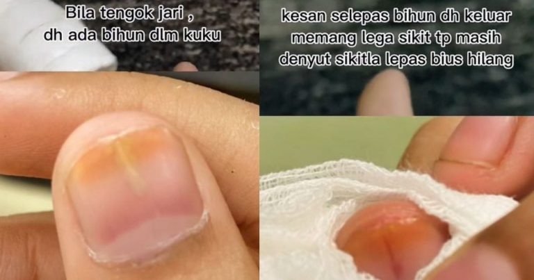 Gadis Kongsi Bihun Kering Termasuk Dalam Kuku. Doktor Bagi Pilihan, Cabut Kuku Atau Cucuk Bius