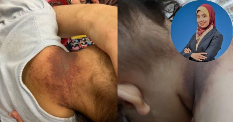 7 Bahan Di Rumah Punca ‘Chemical Burn’. Jika Ada Anak Kecil Tolong Baca!