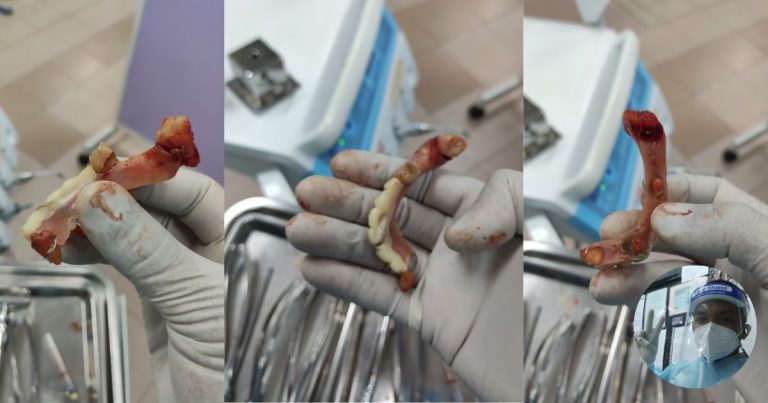 Lelaki Separuh Abad Terpaksa Cabut Semua Gigi Gara-Gara Terima Rawatan Doktor Gigi Palsu!