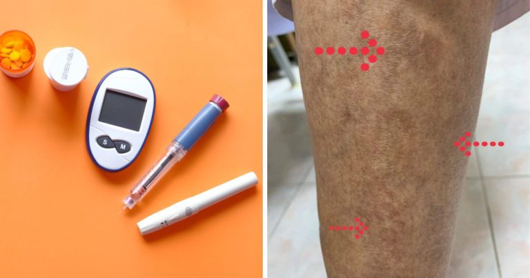 Pastikan Kaki Jangan Sampai Ada Bertompok, Dr Ni Dedahkan Itu Petanda Serius Agar Ramai Faham!