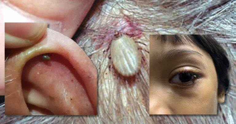 Sengkenit Kalau ‘Melekat’ Pada Kulit, Boleh Buat Lumpuh Muka & Bengkak Hati