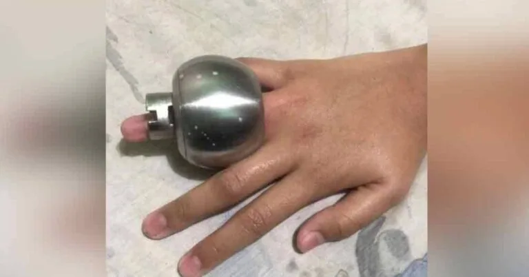 Kanak-kanak Perempuan 11 Tahun Tahan Sakit Lebih Sejam, Jari Manis Tersekat Tombol Pintu