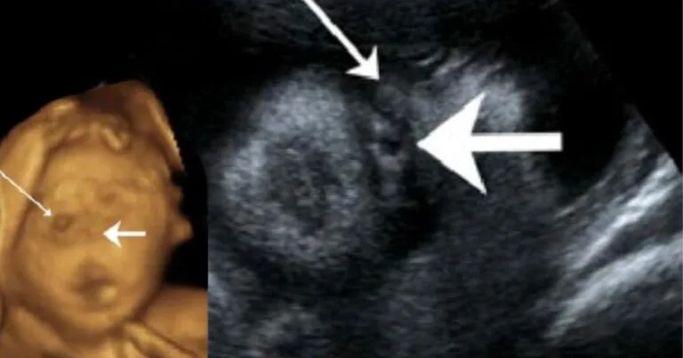 Kes Bayi Hidap Cyclopia, Kejadian Bayi Tidak Cukup Sifat, Ibu Wajib Buka Buku Pink!