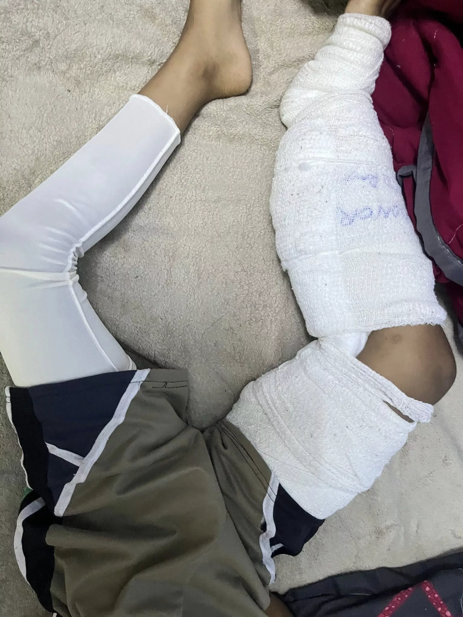 Ibu Sedih Anak Cacat Kekal, Mangsa Kebakaran Ketika Bermain Dengan Rakan