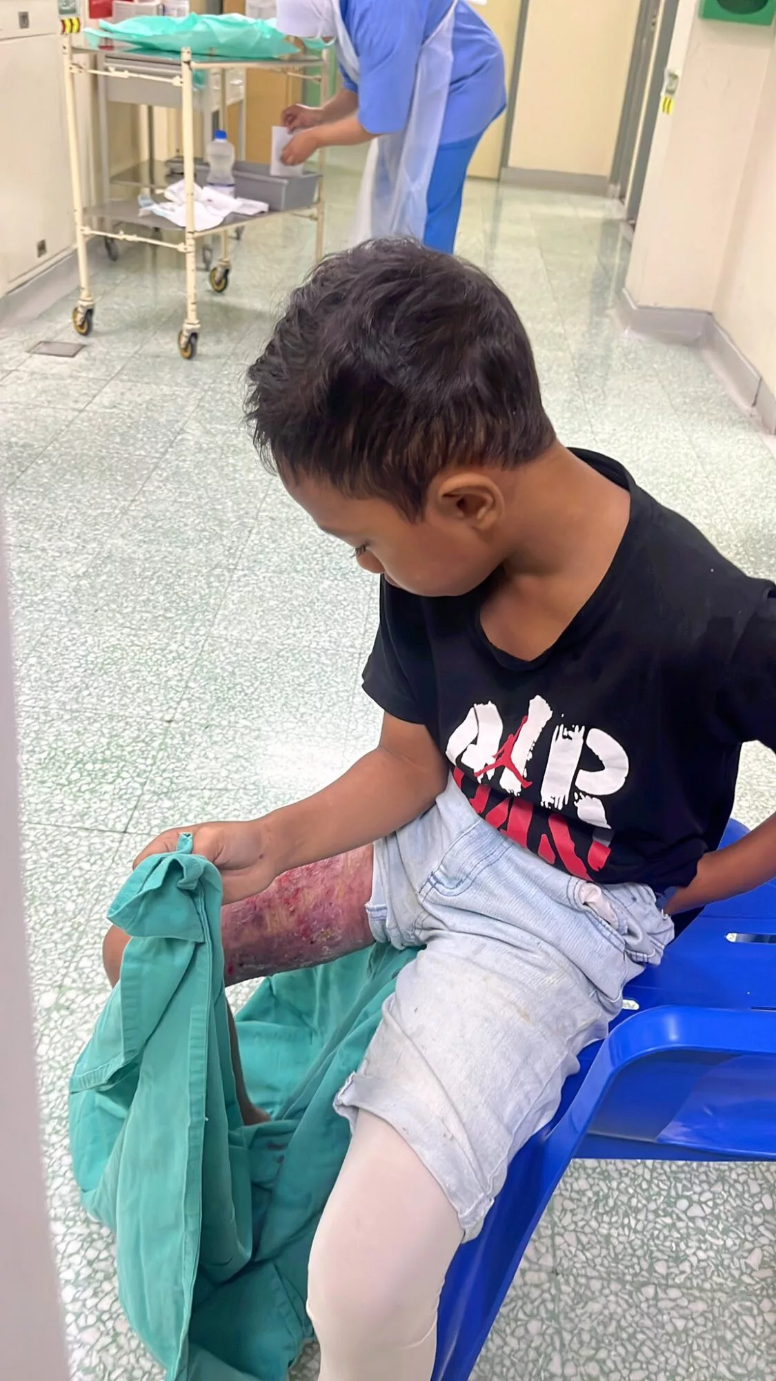 Ibu Sedih Anak Cacat Kekal, Mangsa Kebakaran Ketika Bermain Dengan Rakan