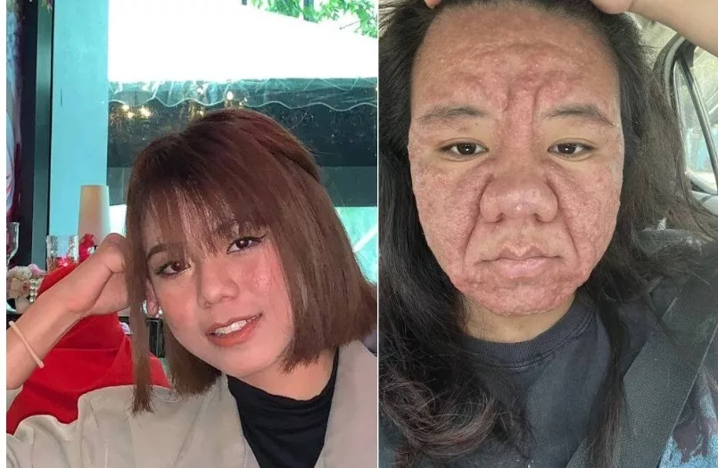 Pernah Tular Wajah Berkedut Ketika Hamil, Lala Kongsi Keadaan Selepas Bersalin, Bukan Penyakit Ain