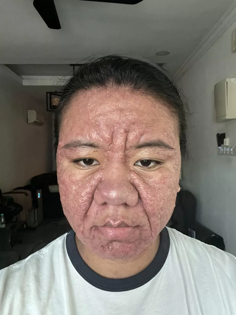 Pernah Tular Wajah Berkedut Ketika Hamil, Lala Kongsi Keadaan Selepas Bersalin, Bukan Penyakit Ain