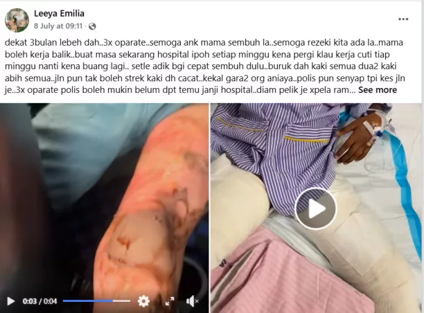 Ibu Sedih Anak Cacat Kekal, Mangsa Kebakaran Ketika Bermain Dengan Rakan