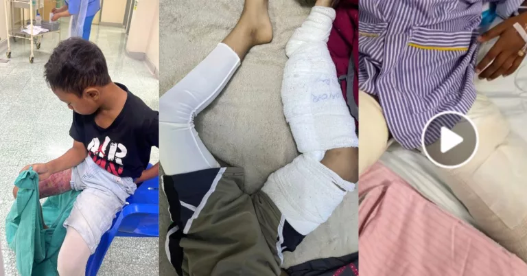 Ibu Sedih Anak Cacat Kekal, Mangsa Kebakaran Ketika Bermain Dengan Rakan