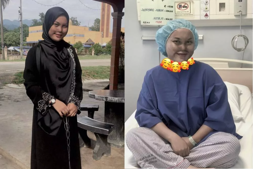 Gadis Mangsa Disimbah Cuka Getah Tak Pernah Berdendam Perbuatan Bapa, Jalani Pembedahan Hidung