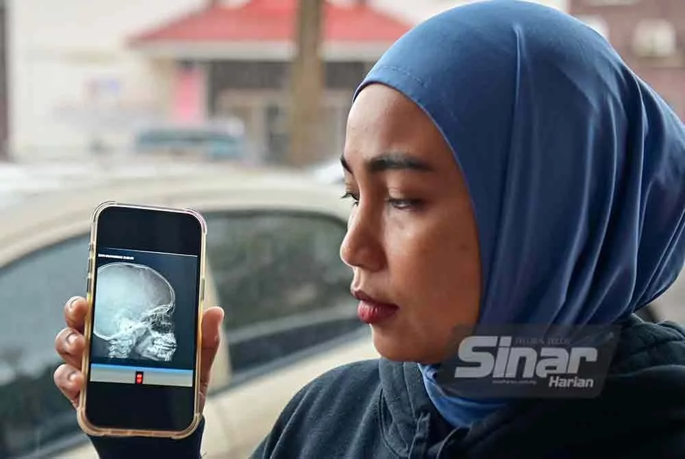 Murid Tahun Dua Patah Tulang Hidung, Retak Tulang Bahagian Mata Akibat Dipukul Rakan Sekolah