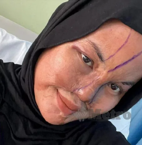 Gadis Mangsa Disimbah Cuka Getah Tak Pernah Berdendam Perbuatan Bapa, Jalani Pembedahan Hidung