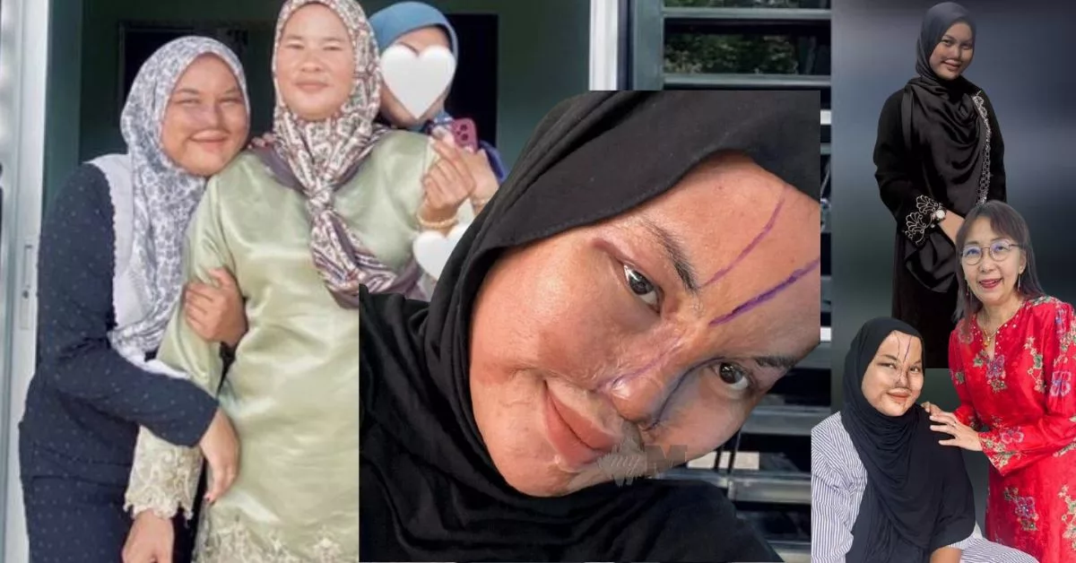 Gadis Mangsa Disimbah Cuka Getah Tak Pernah Berdendam Perbuatan Bapa, Jalani Pembedahan Hidung
