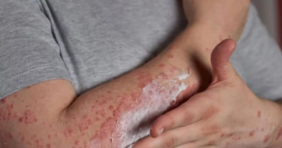 Mpox Di Singapura! 2 Kes Baharu Cetus Kebimbangan, Ini Fakta Penting