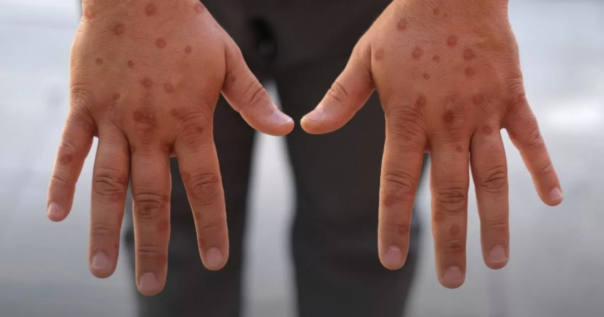 Mpox Di Singapura! 2 Kes Baharu Cetus Kebimbangan, Ini Fakta Penting