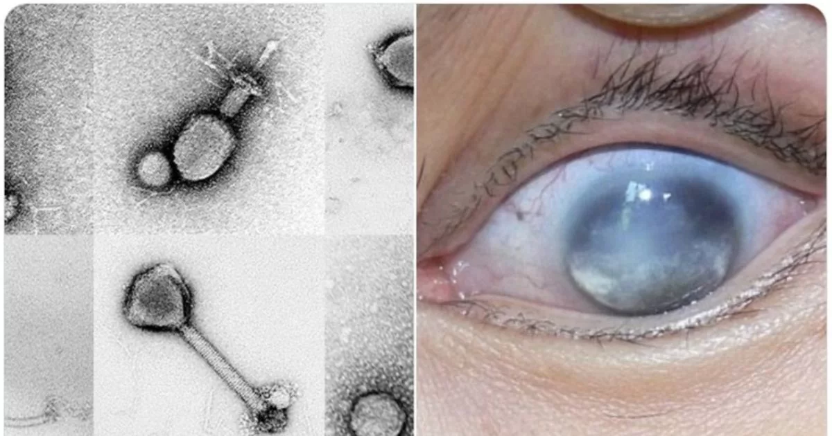 Virus Baharu Makanan Laut! Amaran Penting Tentang Jangkitan Mata Kronik