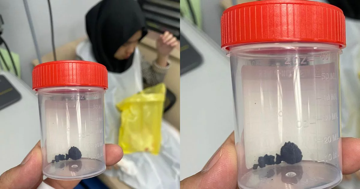 Hidung Anak Berdarah & Hingus Berbau Busuk, Rupanya Gula-Gula Tersangkut Hampir 10 Tahun