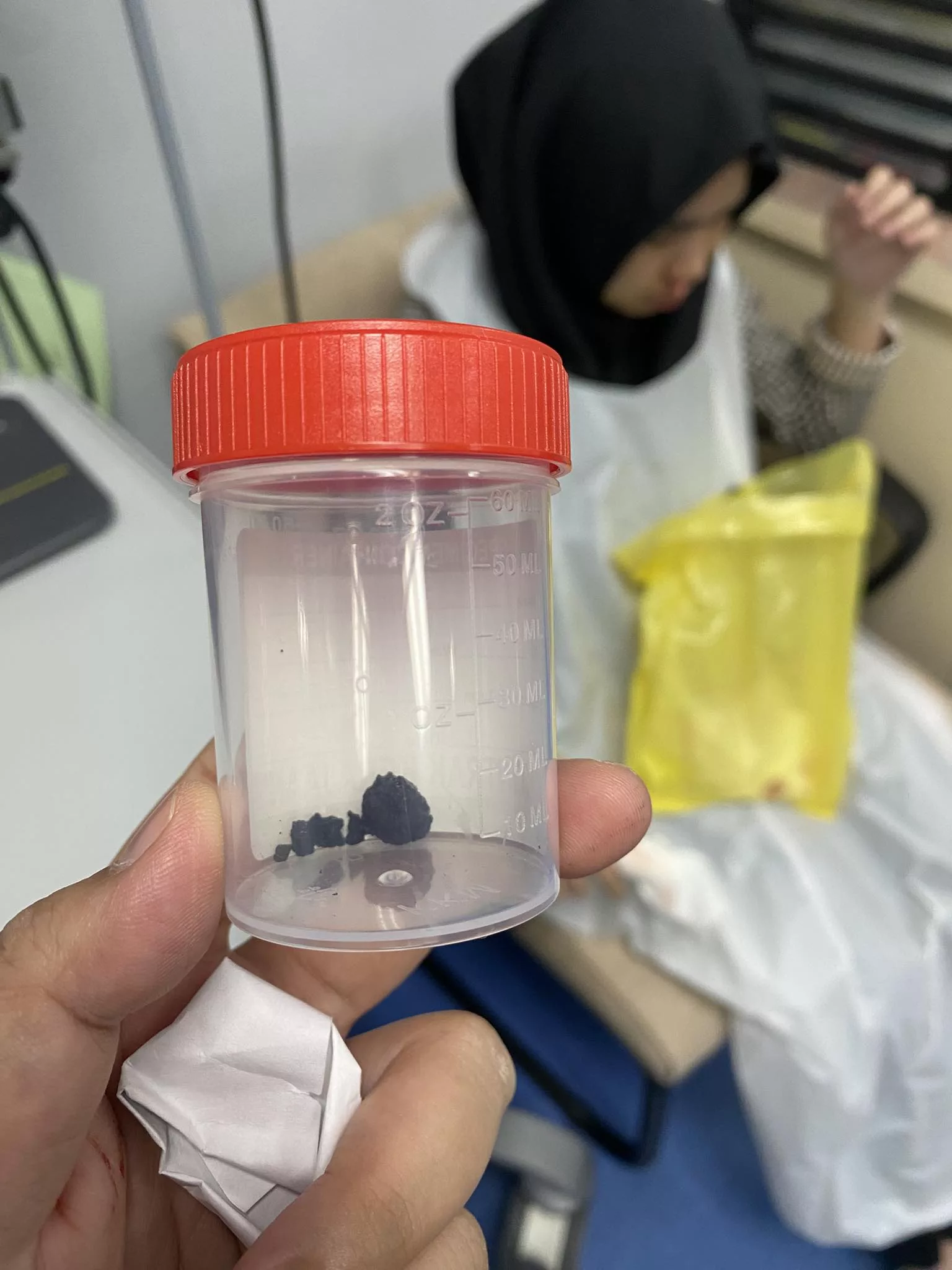 Hidung Anak Berdarah & Hingus Berbau Busuk, Rupanya Gula-Gula Tersangkut Hampir 10 Tahun